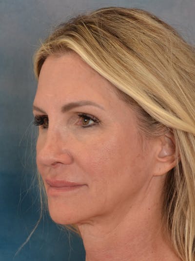 Rhinoplasty Before & After Gallery - Patient 603359 - Image 4
