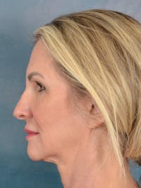 Rhinoplasty Before & After Gallery - Patient 603359 - Image 1