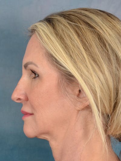 Rhinoplasty Before & After Gallery - Patient 603359 - Image 1