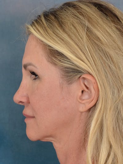 Rhinoplasty Before & After Gallery - Patient 603359 - Image 2