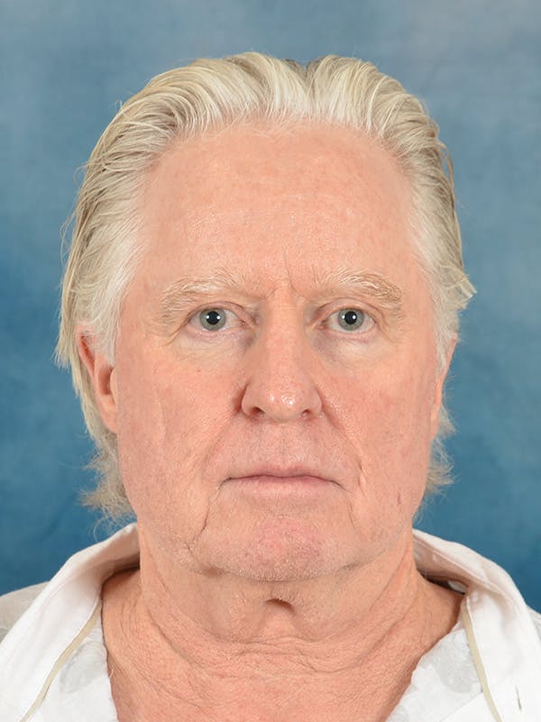 Deep Plane Facelift Before & After Gallery - Patient 711507 - Image 5