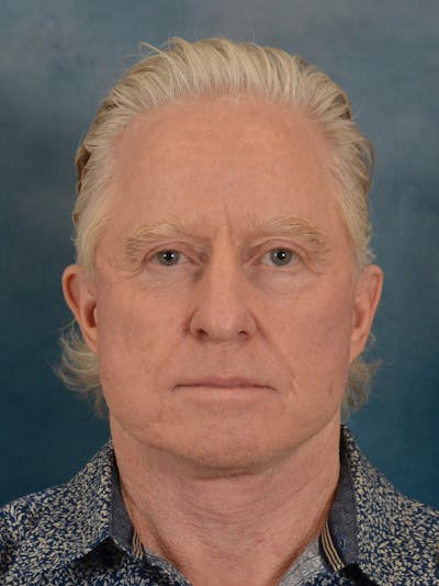 Deep Plane Facelift Before & After Gallery - Patient 711507 - Image 6