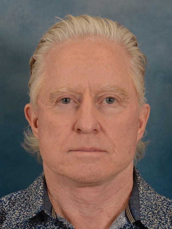 Deep Plane Facelift Before & After Gallery - Patient 711507 - Image 6