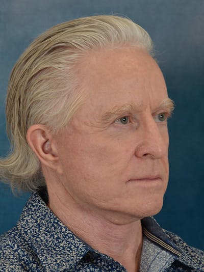 Deep Plane Facelift Before & After Gallery - Patient 711507 - Image 8