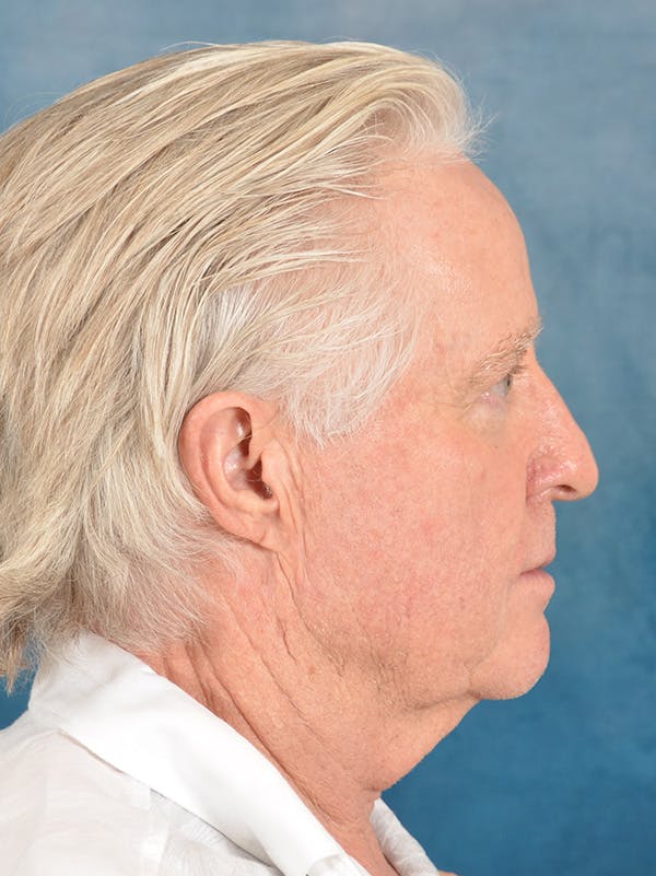 Deep Plane Facelift Before & After Gallery - Patient 711507 - Image 9