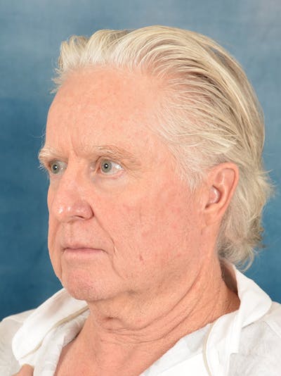 Deep Plane Facelift Before & After Gallery - Patient 711507 - Image 1