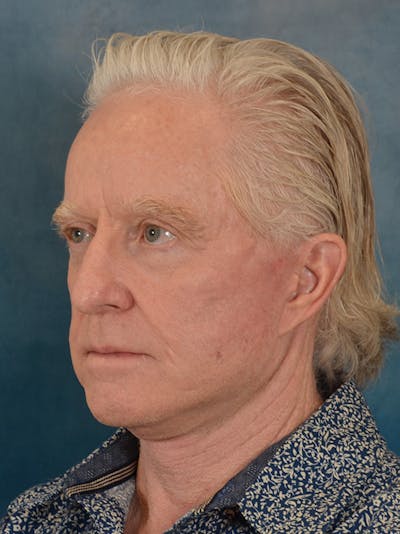 Deep Plane Facelift Before & After Gallery - Patient 711507 - Image 2
