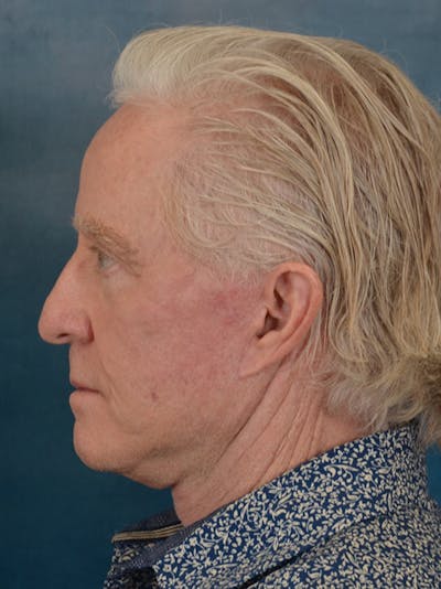 Deep Plane Facelift Before & After Gallery - Patient 711507 - Image 4