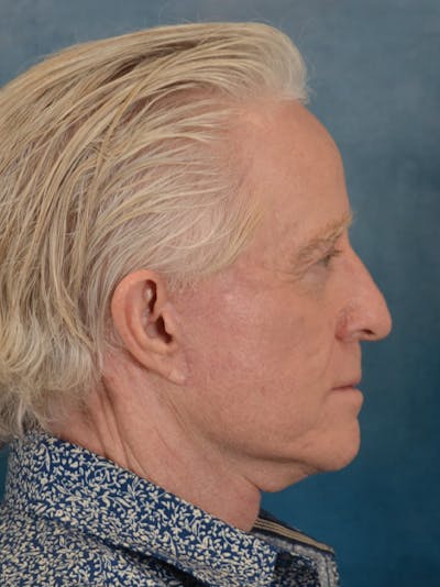 Deep Plane Facelift Before & After Gallery - Patient 711507 - Image 10