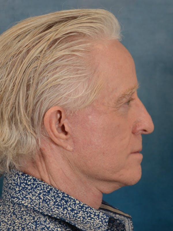 Deep Plane Facelift Before & After Gallery - Patient 711507 - Image 10