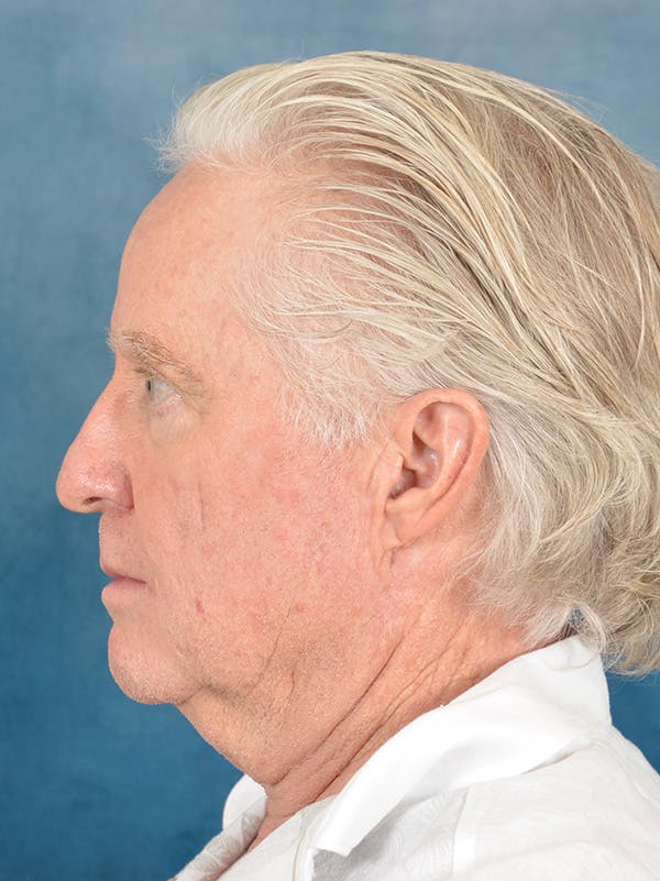 Deep Plane Facelift Before & After Gallery - Patient 711507 - Image 3