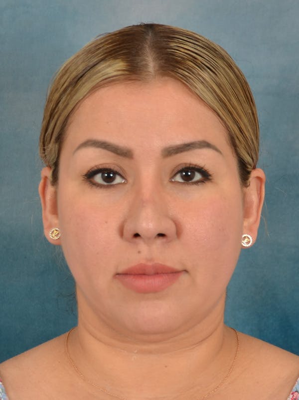 Rhinoplasty Before & After Gallery - Patient 664576 - Image 6