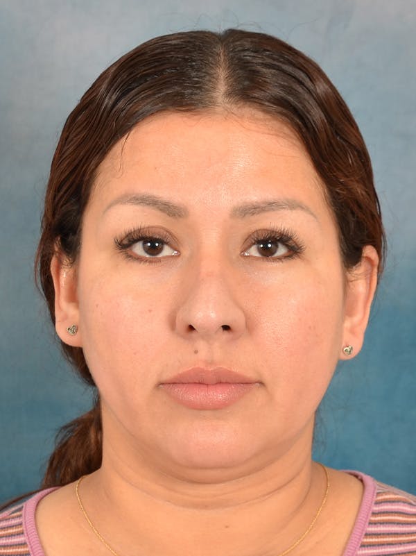 Rhinoplasty Before & After Gallery - Patient 664576 - Image 5