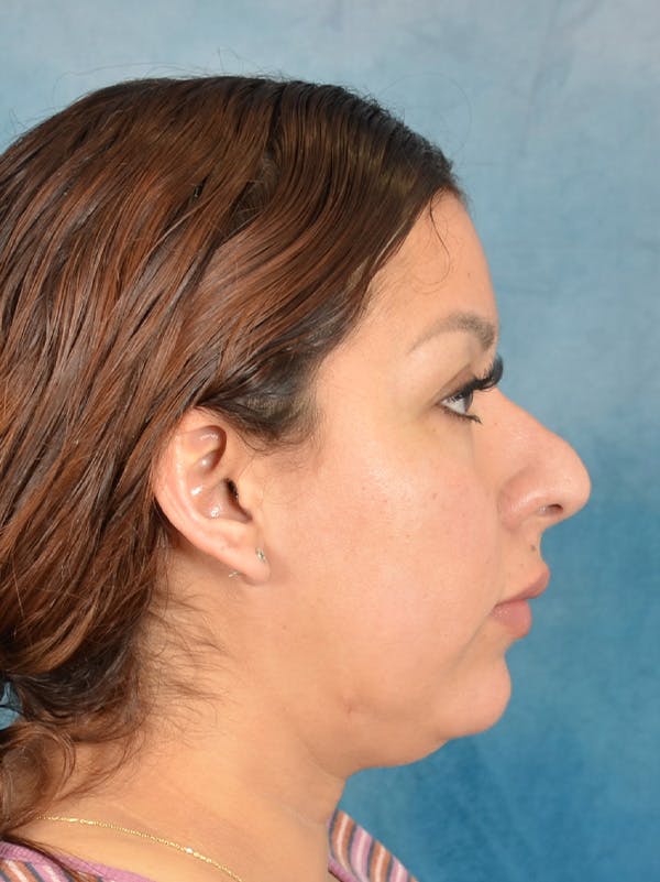 Rhinoplasty Before & After Gallery - Patient 664576 - Image 9