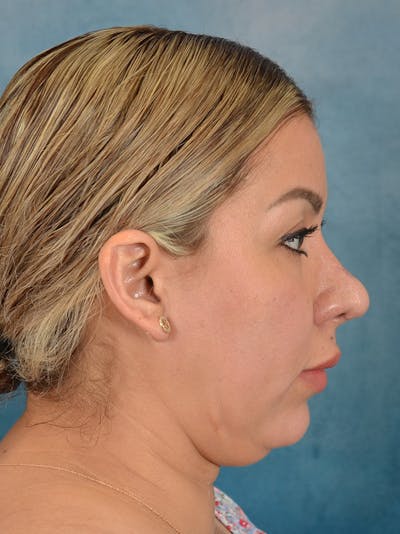 Rhinoplasty Before & After Gallery - Patient 664576 - Image 10