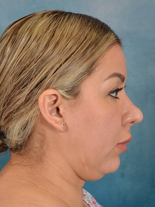 Rhinoplasty Before & After Gallery - Patient 664576 - Image 10