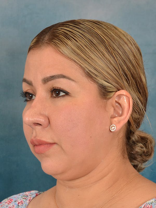 Rhinoplasty Before & After Gallery - Patient 664576 - Image 4