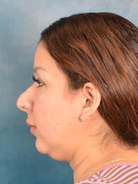 Rhinoplasty Before & After Gallery - Patient 664576 - Image 1