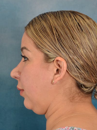 Rhinoplasty Before & After Gallery - Patient 664576 - Image 2