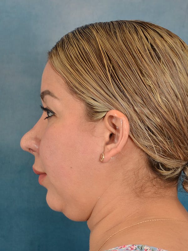 Rhinoplasty Before & After Gallery - Patient 664576 - Image 2