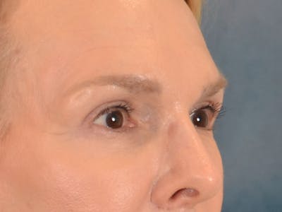 Eyelid Lift Before & After Gallery - Patient 537453 - Image 4