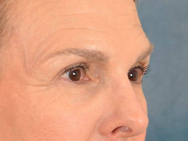 Eyelid Lift Before & After Gallery - Patient 537453 - Image 3