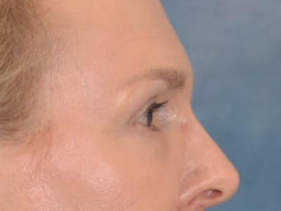 Eyelid Lift Before & After Gallery - Patient 537453 - Image 6