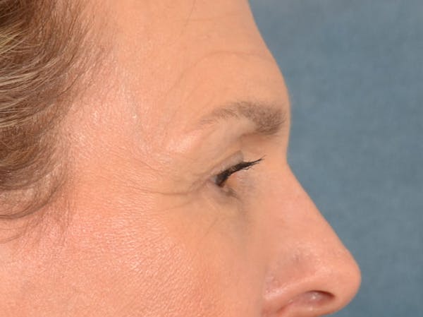 Eyelid Lift Before & After Gallery - Patient 537453 - Image 5