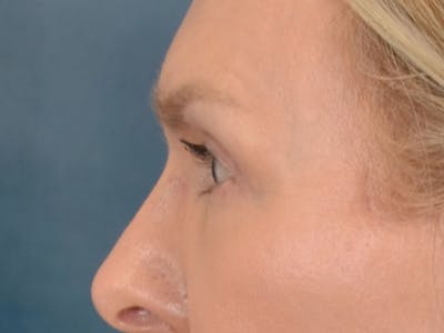 Eyelid Lift Before & After Gallery - Patient 537453 - Image 8