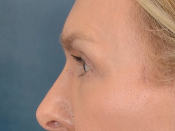 Eyelid Lift Before & After Gallery - Patient 537453 - Image 8