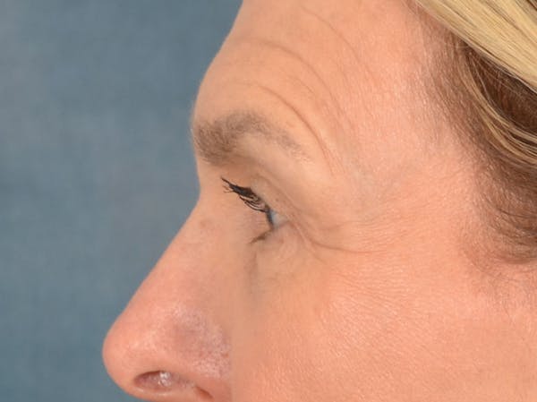 Eyelid Lift Before & After Gallery - Patient 537453 - Image 7