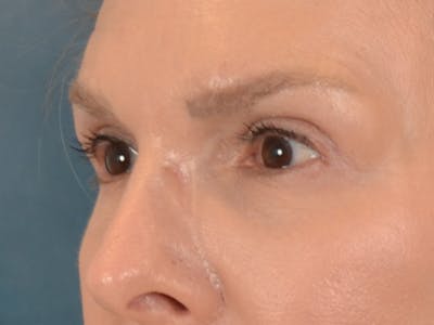 Eyelid Lift Before & After Gallery - Patient 537453 - Image 10