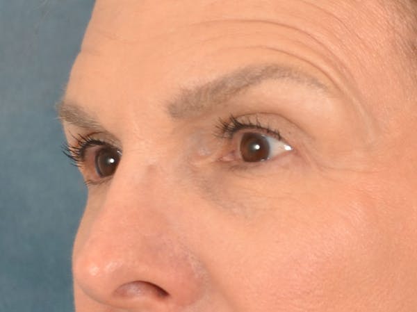 Eyelid Lift Before & After Gallery - Patient 537453 - Image 9