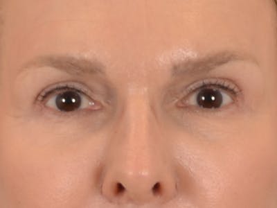 Eyelid Lift Before & After Gallery - Patient 537453 - Image 2
