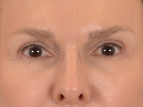 Eyelid Lift Before & After Gallery - Patient 537453 - Image 2