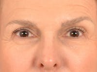 Eyelid Lift Before & After Gallery - Patient 537453 - Image 1