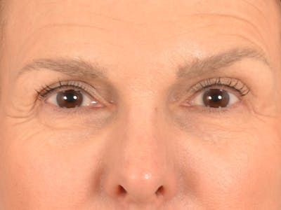 Eyelid Lift Before & After Gallery - Patient 537453 - Image 1