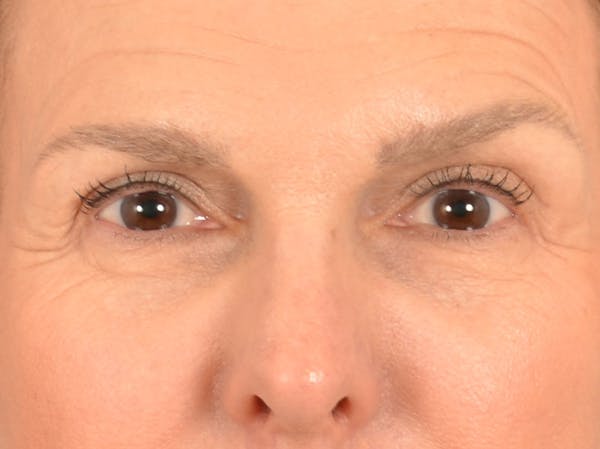 Eyelid Lift Before & After Gallery - Patient 537453 - Image 1