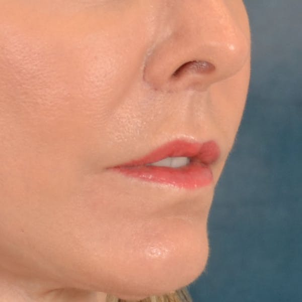 Lip Lift Before & After Gallery - Patient 157502 - Image 4