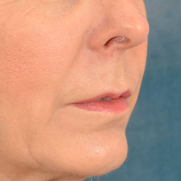 Lip Lift Before & After Gallery - Patient 157502 - Image 3