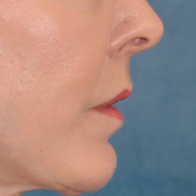 Lip Lift Before & After Gallery - Patient 157502 - Image 6