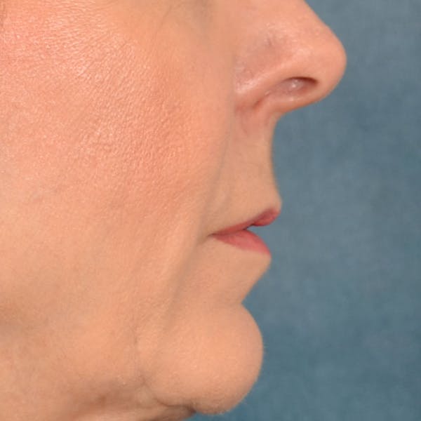 Lip Lift Before & After Gallery - Patient 157502 - Image 5