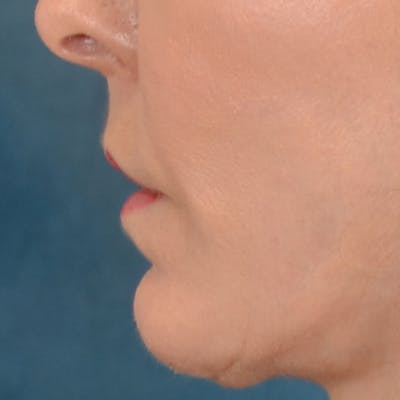 Lip Lift Before & After Gallery - Patient 157502 - Image 8