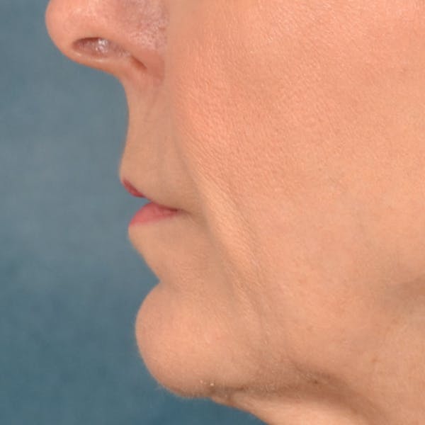 Lip Lift Before & After Gallery - Patient 157502 - Image 7