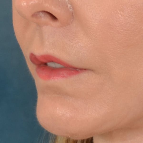 Lip Lift Before & After Gallery - Patient 157502 - Image 10