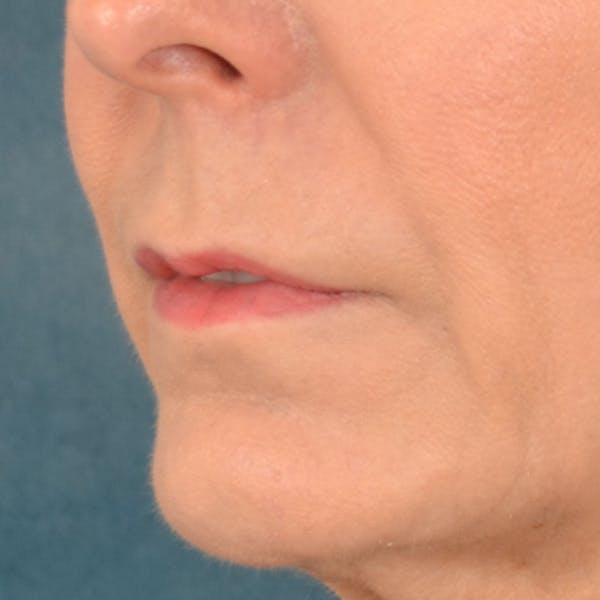 Lip Lift Before & After Gallery - Patient 157502 - Image 9