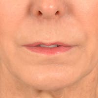 Lip Lift Before & After Gallery - Patient 157502 - Image 1