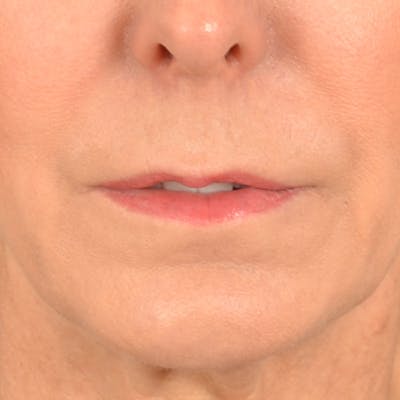 Lip Lift Before & After Gallery - Patient 157502 - Image 1