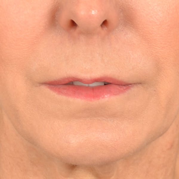 Lip Lift Before & After Gallery - Patient 157502 - Image 1