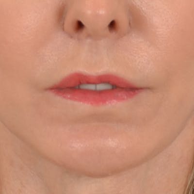 Lip Lift Before & After Gallery - Patient 157502 - Image 2